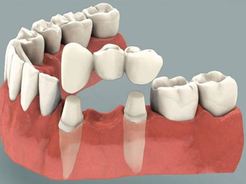 crown-bridge-willow-springs-dental