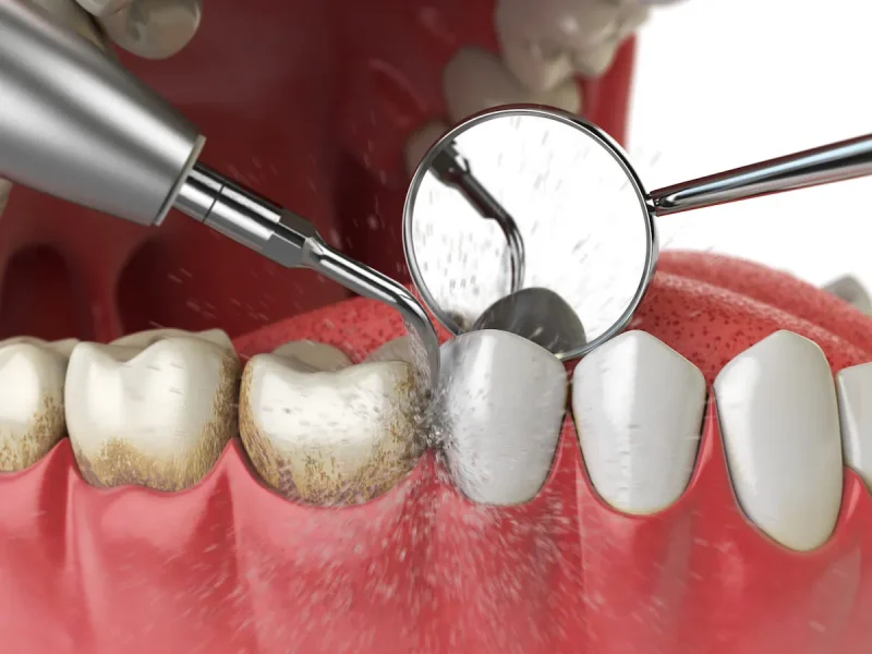 e9457e14-4639-4ff0-a3bc-636547bb4c6f-amd_teeth_cleaning_A4F2C3_haD