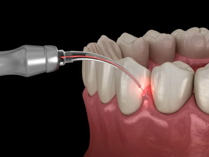 types-of-gum-surgery-and-why-you-might-need-one