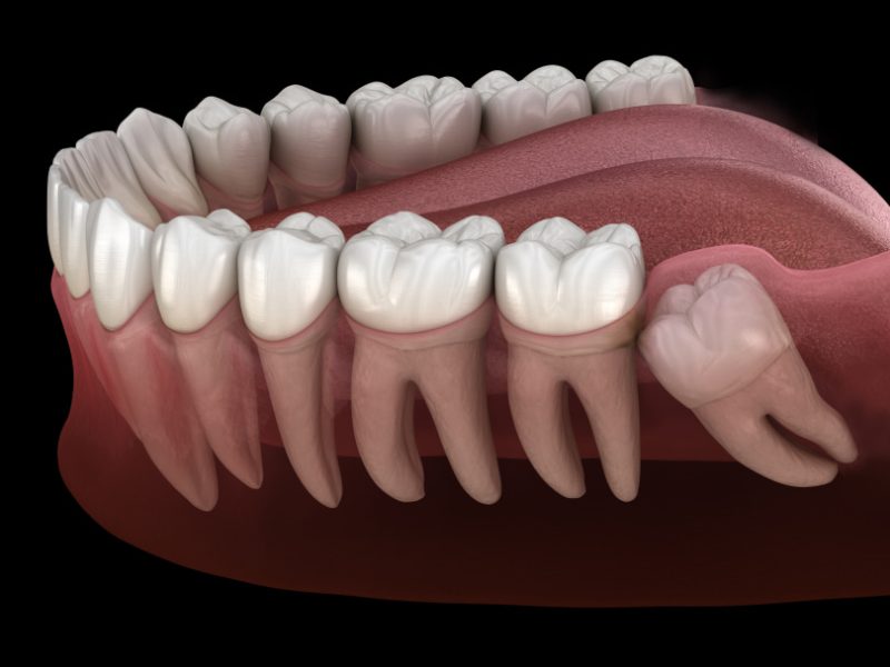 wisdom-teeth-removal-img